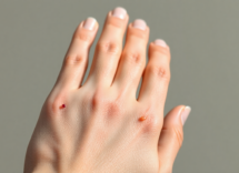 angiocheratoma cosa sapere su questa condizione cutanea 1749009585